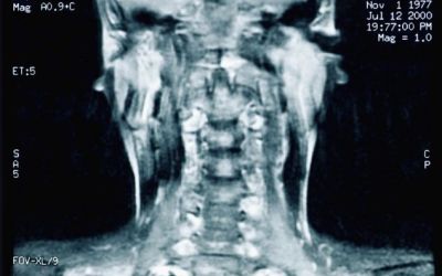 Transplantul de cap, ca-n celebrul roman Frankenstein, ar putea fi posibil curand
