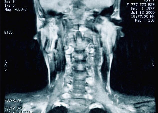 Transplantul de cap, ca-n celebrul roman Frankenstein, ar putea fi posibil curand Transplantul De Cap Ca N Celebrul Roman Frankenstein Ar Putea Fi Posibila Curand