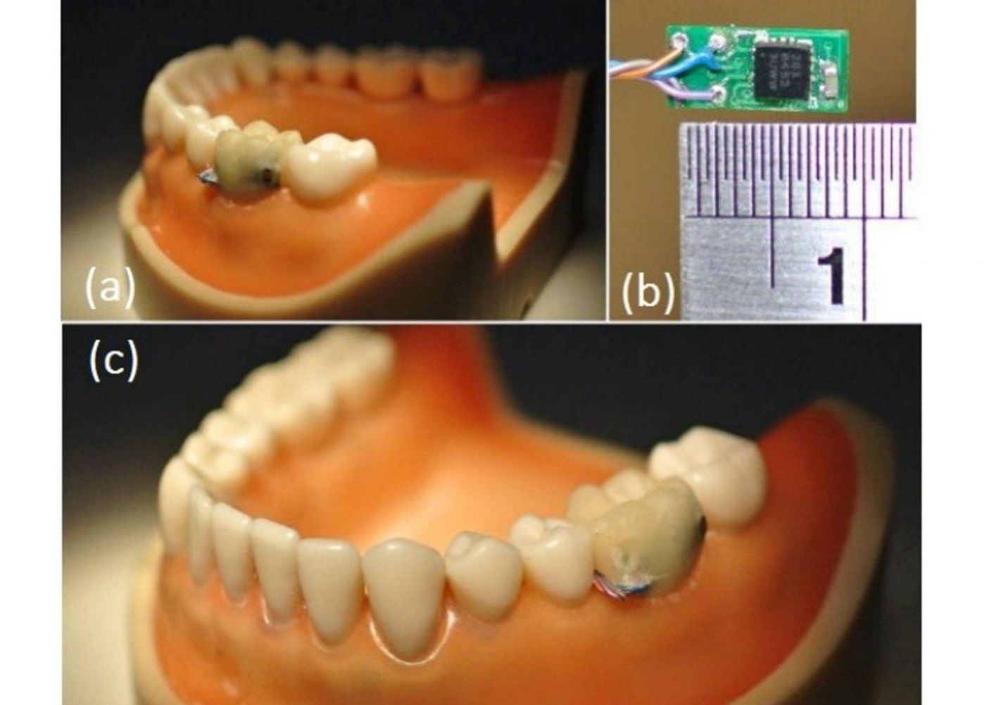 Un senzor plantat intr-un dinte inteligent il poate avertiza pe posesor cand acesta face excese Un Senzor Plantat Intr Un Dinte Inteligent Il Poate Avertiza Pe Posesor Cand Mananca Mult