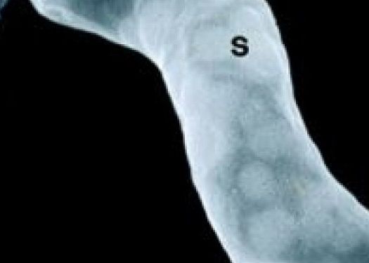 Cercetatorii au modificat genetic o bacterie, care va vana celulele canceroase Cercetatorii Au Modificat Genetic O Bacterie Care Va Vana Celulele Canceroase
