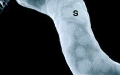 Cercetatorii au modificat genetic o bacterie, care va vana celulele canceroase