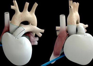 Premiera Mondiala In Medicina O Inima Artificiala A Fost Implantata In Franta