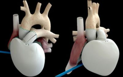 Premiera mondiala in medicina: O inima artificiala a fost implantata in Franta