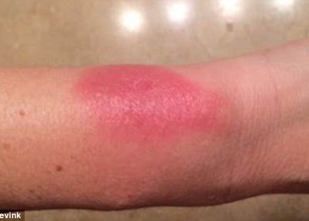 Fitbit Recunoaste Ca Bratarile Dedicate Celor Care Le Folosesc Pentru Fitness Pot Produce Alergii