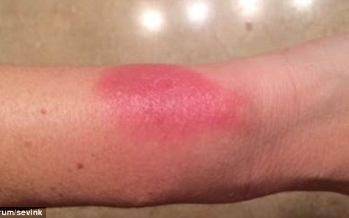 Fitbit Recunoaste Ca Bratarile Dedicate Celor Care Le Folosesc Pentru Fitness Pot Produce Alergii