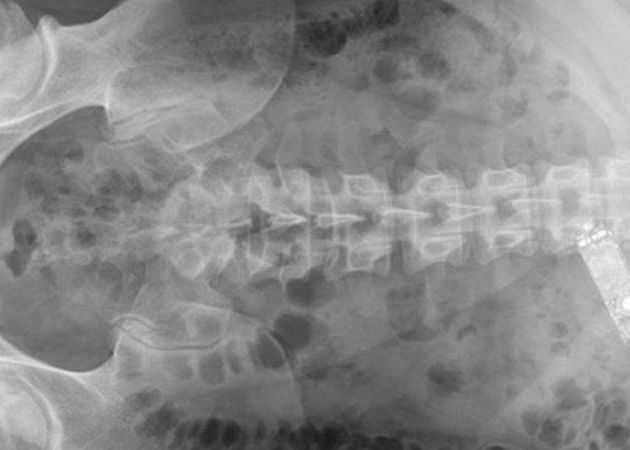 Un Detinut A Inghitit Un Telefon Mobil Ca Sa L Ascunda De Gardieni Ce A Patit Cand A Incercat Sa L Scoata