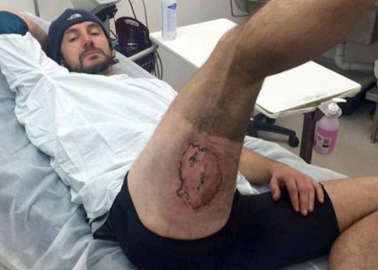 A suferit arsuri ingrozitoare din cauza unui iPhone pe care il tinea in buzunar. Cum s-a intamplat A Suferit Arsuri Ingrozitoare Din Cauza Unui Iphone Pe Care Il Tinea In Buzunar Cum S A Intamplat