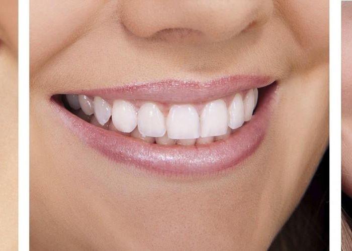 P Cat Trebuie Sa Scoti Din Buzunar Pentru Un Implant Dentar Si Cat De Mult Isi Merita Banii