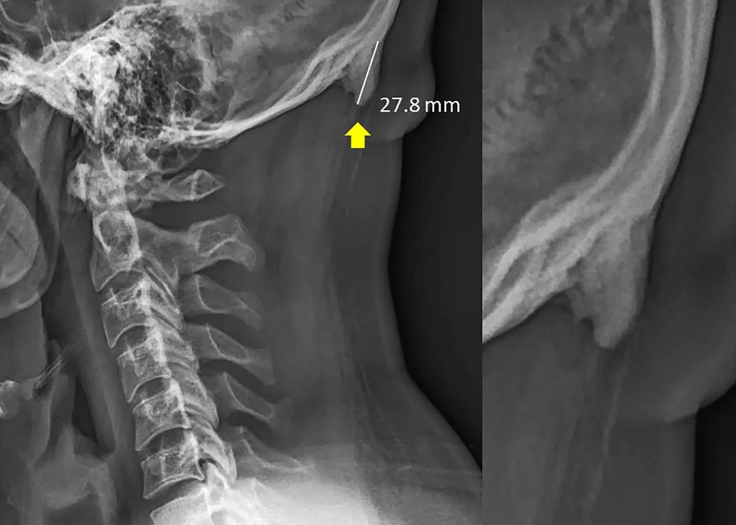 Descoperire Surprinzatoare Cum Deformeaza Craniul Folosirea Indelungata A Telefoanelor Mobile