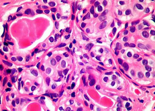Descoperirea care ar putea ajuta la tratarea tuturor formelor de cancer Descoperirea Care Ar Putea Ajuta La Tratarea Tuturor Formelor De Cancer