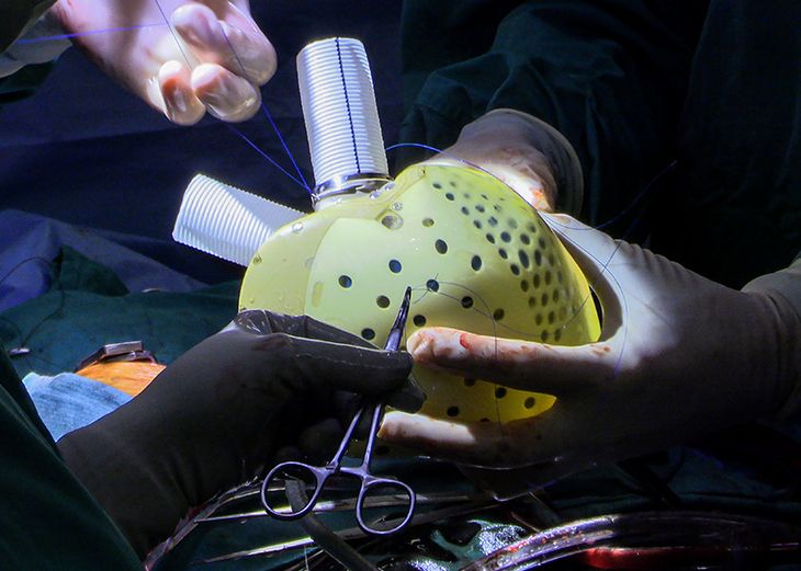 Primul Implant De Inima Artificiala Din Lume Cum Functioneaza Dispozitivul