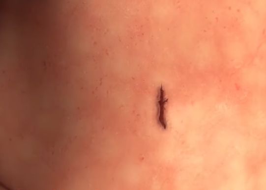 Adezivul Elastic Poate Sigila Ranile In 60 De Secunde