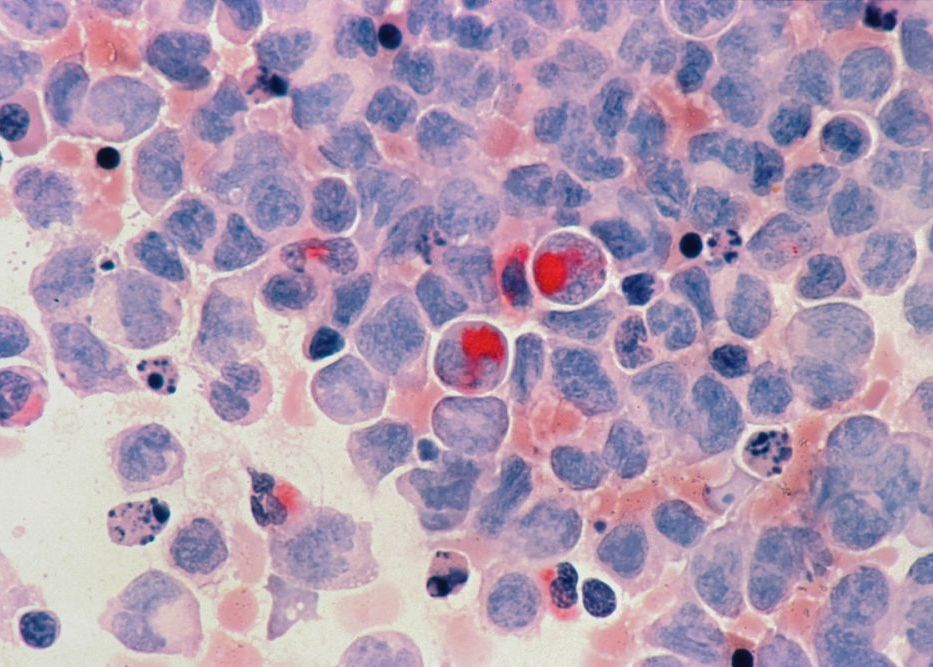 Care Ar Fi Cauzele Aparitiei Cancerului Un Studiu Major Ofera Noi Indicii