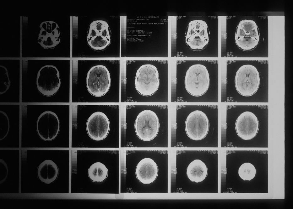 Vaccinul Care Are Potentialul De A Trata Tumorile Cerebrale