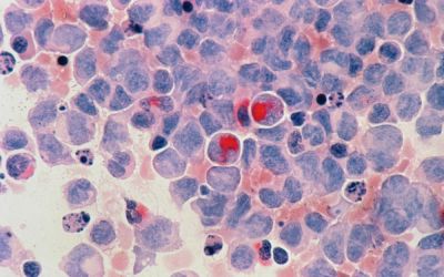 Premieră extraordinară în medicină. O fetiță de 13 ani s-a vindecat de leucemie după ce a primit o terapie prin inginerie celulară