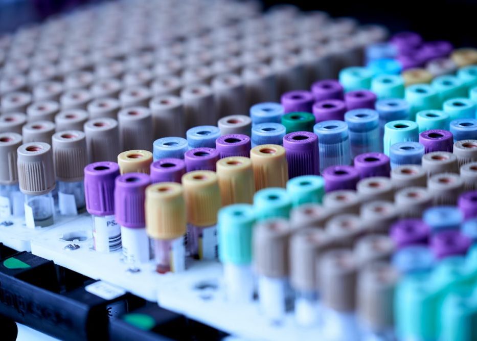 Cercetatorii Au Dezvoltat Un Test De Sange Care Poate Detecta Boala Alzheimer