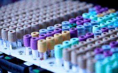 Cercetătorii au dezvoltat un test de sânge care poate detecta boala Alzheimer
