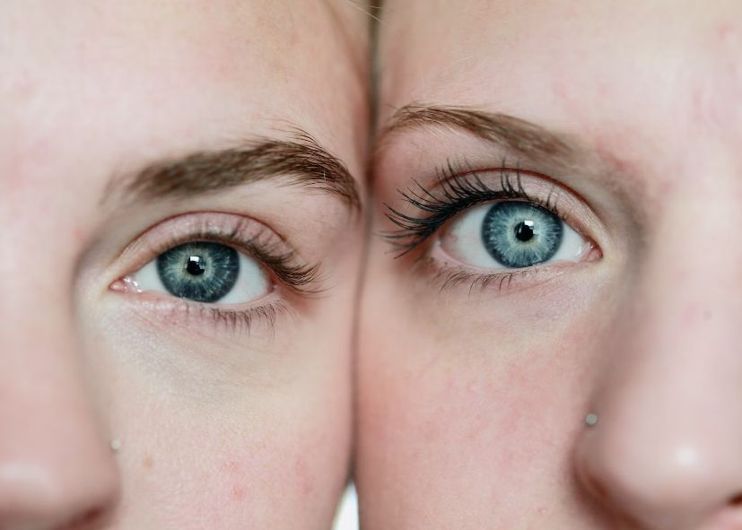 Misterul Gemenilor Identici Cand Unul Dintre Ei Sufera De Dementa Amandoi Au O Viata Mai Scurta