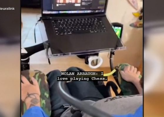 Primul pacient cu un cip Neuralink implantat în creier joacă acum șah doar cu puterea minții. VIDEO Primul Pacient Cu Un Cip Neuralink Implantat In Creier Joaca Acum Sah Doar Cu Puterea Mintii